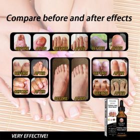 EELHOE Nail Repair Solution, Thickening And Brightening Nails Removing Gray Nail Repair Nourishing Nail Care Solution (Quantity: 1pc)